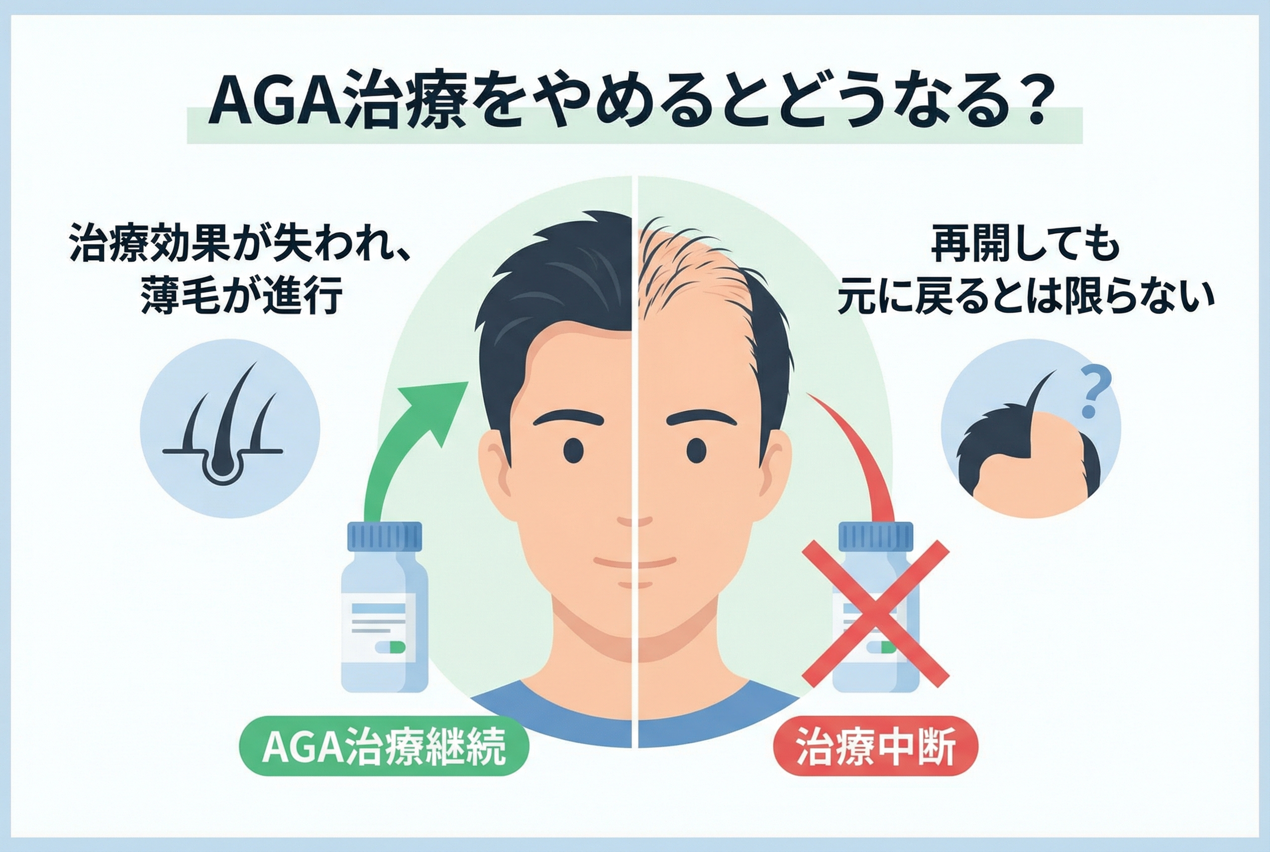 AGA治療をやめると薄毛は再び進行するのか